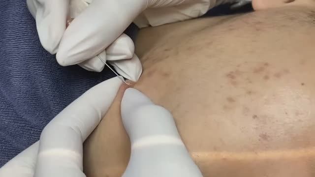 Asmr. Профессиональное очищение от комедонов.