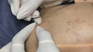 Asmr. Профессиональное очищение от комедонов.