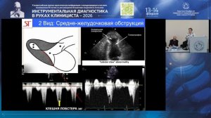 Гипертрофическая кардиомиопатия