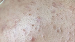 ЛЕЧЕНИЕ АКНЕ удовлетворение и релакс в одном флаконе.