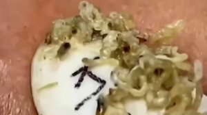 #184 Чистка лица от угрей и акне. Выдавливание прыщей. Удаление черных точек и комедонов