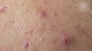 Удаление воспаленных прыщей. Часть 2 #HMS62