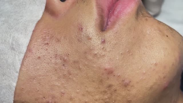 УСПОКАИВАЮЩЕЕ УДАЛЕНИЕ АКНЕ — смотрите и расслабляйтесь! #608