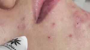 Самые сложные случаи акне, которые нельзя пропустить! 604