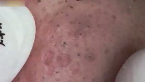 Asmr. Механическая чистка от прыщей. 2154