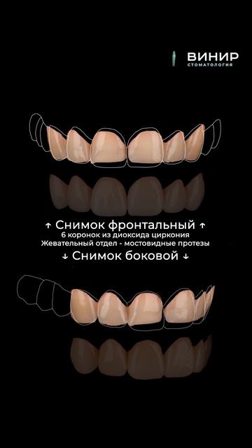 Протезирование зубов.