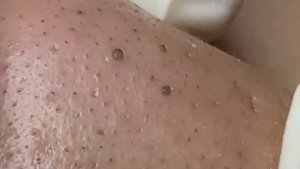 Asmr. Чистим кожу от акне и угревой сыпи 2158