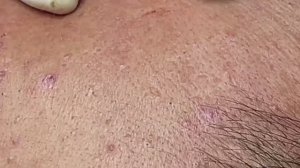 Очищение лица от угрей. Расслаблющее видео. #24 Часть 4