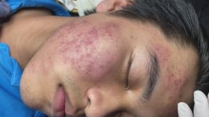 ШОК! Угревая сыпь и черные точки исчезают после этой новой процедуры 033