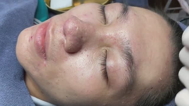 Новое лечение акне убирает все комедоны 027