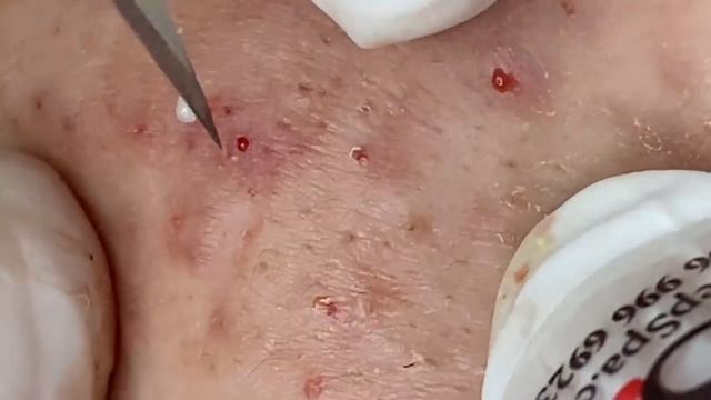 Выдавливание прыщей, угрей, черных точек и камедонов #286