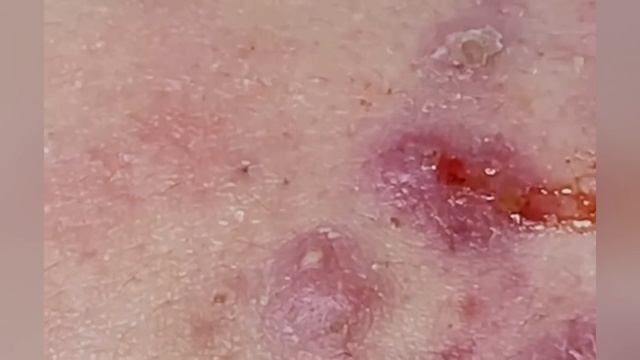 Выдавливание прыщей, угрей, черных точек и камедонов #285