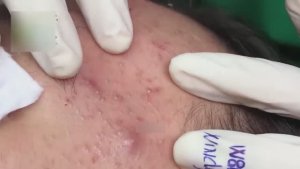 Очищение кожи от угревой сыпи WS#2