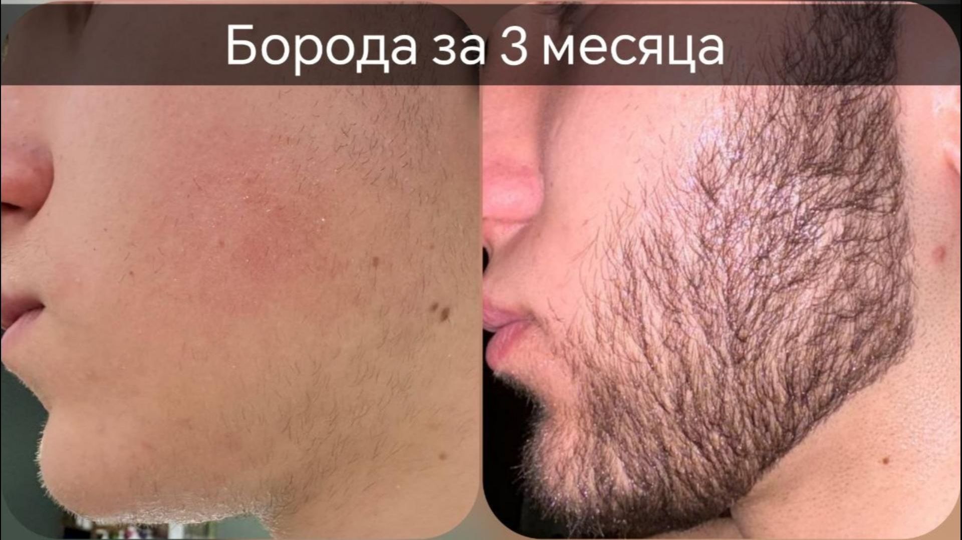 Забудь про миноксидил, реальный способ как отрастить бороду. Андрей борода