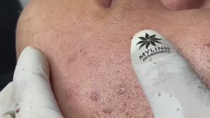 Очищение лица от угрей. Расслаблющее видео. #23 Часть 3