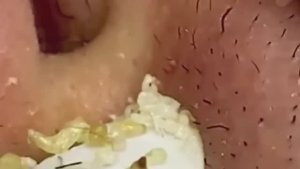 #187 Чистка лица от угрей и акне. Выдавливание прыщей. Удаление черных точек и комедонов