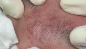 Очищение лица от черных точек. WS#3