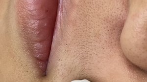 ЛЕЧЕНИЕ АКНЕ удовлетворение и релакс