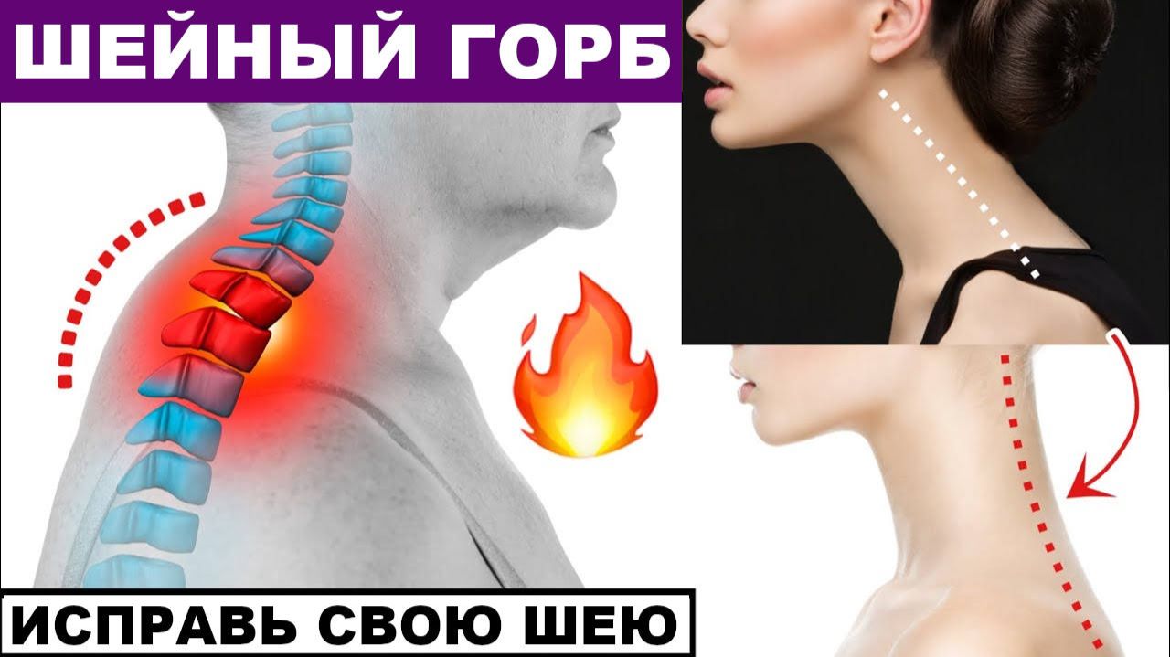 Как исправить шейный горб. Можно  делать сидя или стоя.