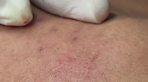 Профессионально чистим кожу от Acne в клинике #20