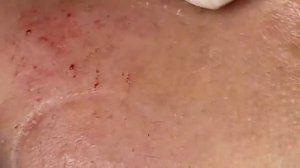 Выдавливание прыщей, угрей, черных точек и камедонов #289