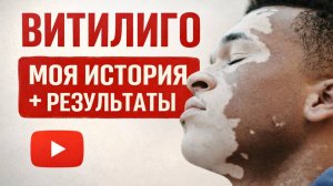 Моя история витилиго