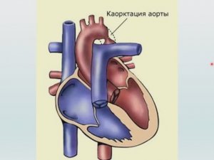 Занятие - 8-2 - Врожденные пороки сердца