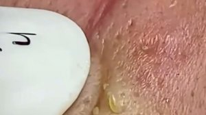 #191 Чистка лица от угрей и акне. Выдавливание прыщей. Удаление черных точек и комедонов