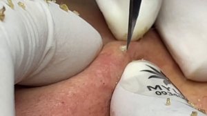 Очищение лица от угрей. Расслабляющее видео. #22 Часть 2