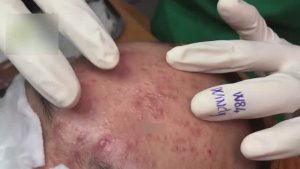 Механическое очищение от акне. Расслабляющее видео WS#1