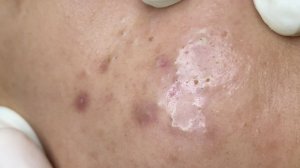 ЛЕЧЕНИЕ АКНЕ удовлетворение и релакс