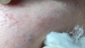 Выдавливание прыщей, угрей, черных точек и камедонов #288