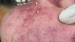 Чистим кожу от закрытых комедонов WS