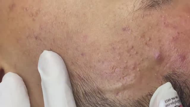 030 • Relax Spa • АСМР • Acne collection