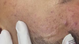 030 • Relax Spa • АСМР • Acne collection