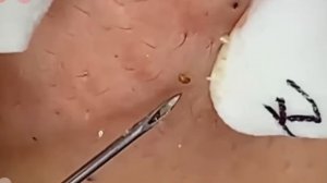 #192 Чистка лица от угрей и акне. Выдавливание прыщей. Удаление черных точек и комедонов