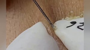 Выдавливание прыщей, угрей, черных точек и камедонов #292