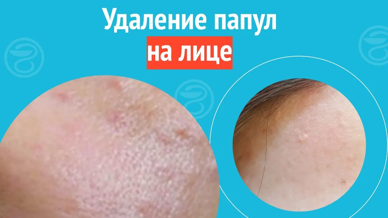 👩_🦰 Удаление папул на лице. Клинический случай №1405