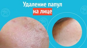 👩_🦰 Удаление папул на лице. Клинический случай №1405