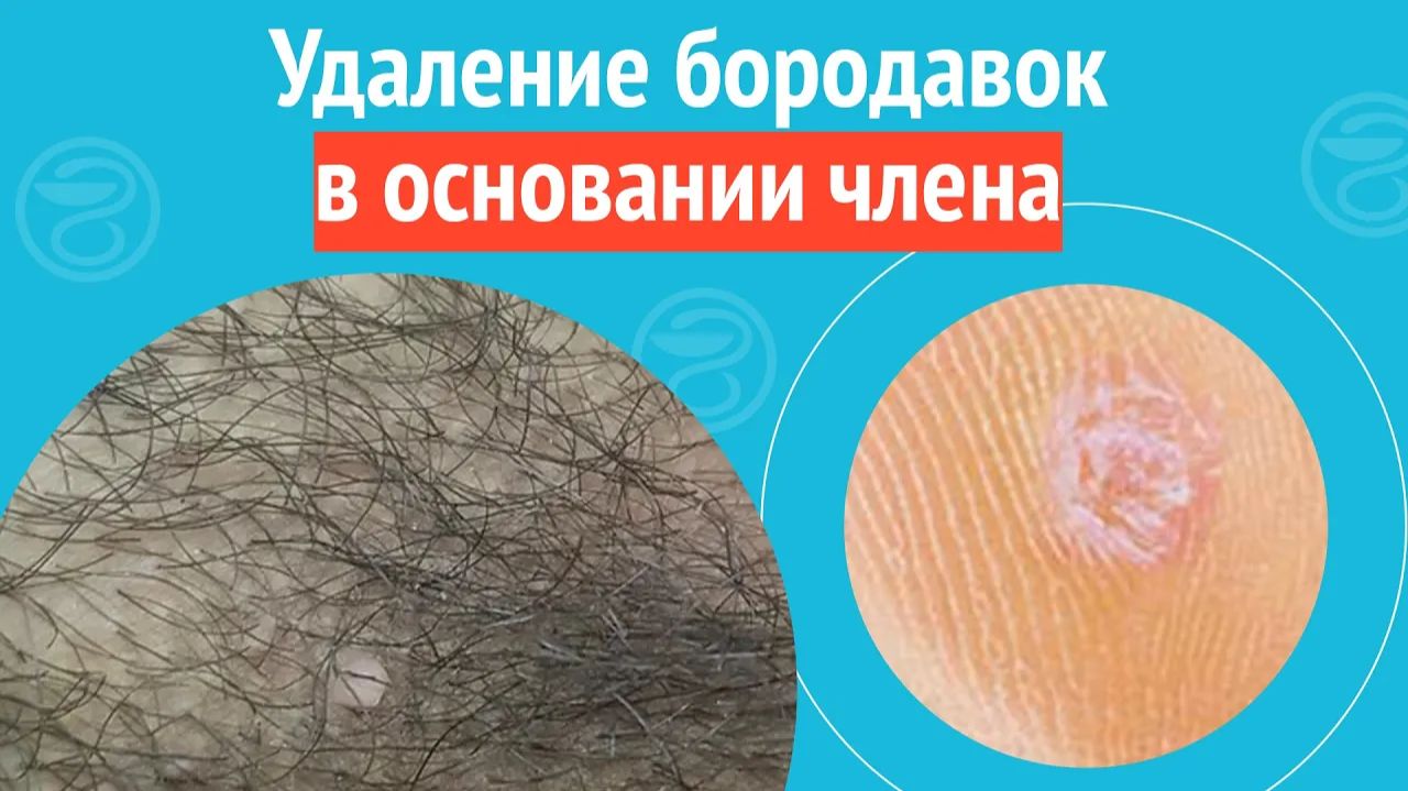 ✅ Удаление бородавок в основании члена. Клинический случай №1407 смотреть онлайн