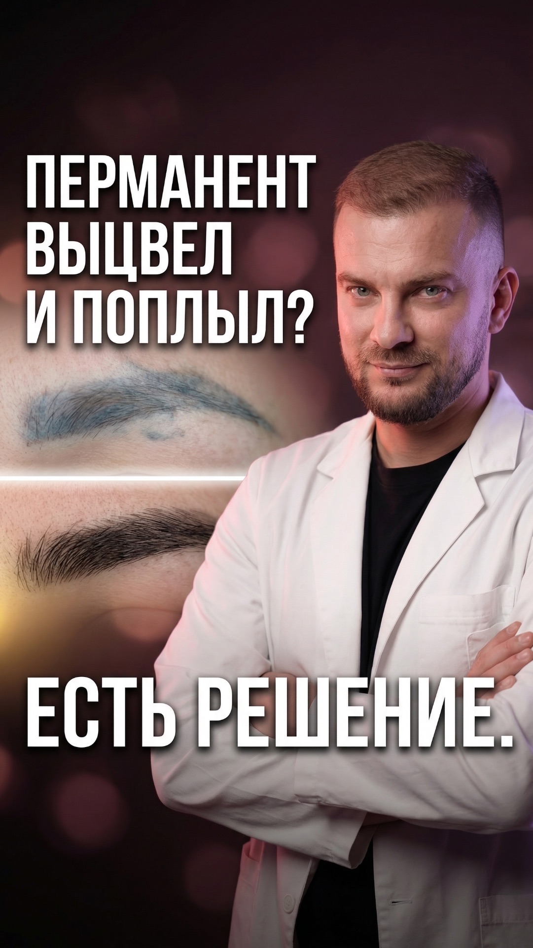 Пересадка бровей поверх татуажа — как это работает и что получается через 6 месяцев