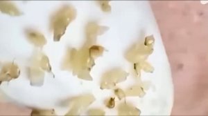 #194 Чистка лица от угрей и акне. Выдавливание прыщей. Удаление черных точек и комедонов