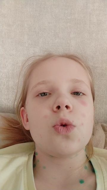 1 пост.( Ветрянка у меня)