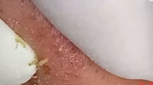 #195 Чистка лица от угрей и акне. Выдавливание прыщей. Удаление черных точек и комедонов