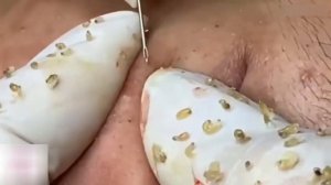 НЕВОЗМОЖНО ОТОРВАТЬСЯ! Удаление черных точек и прыщей — смотреть обязательно