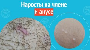 😧 Наросты на члене и анусе. Клинический случай №1404