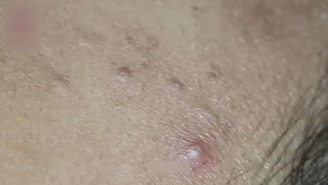 Извлечение крупных кистозных угрей и черных точек — выдавливание прыщей