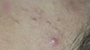 Извлечение крупных кистозных угрей и черных точек — выдавливание прыщей