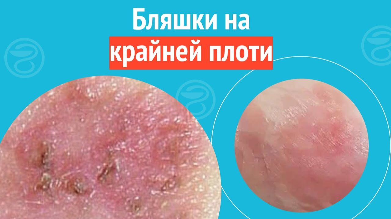 ☹️ Бляшки на крайней плоти. Клинический случай №1406 смотреть онлайн