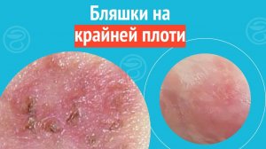 ☹️ Бляшки на крайней плоти. Клинический случай №1406